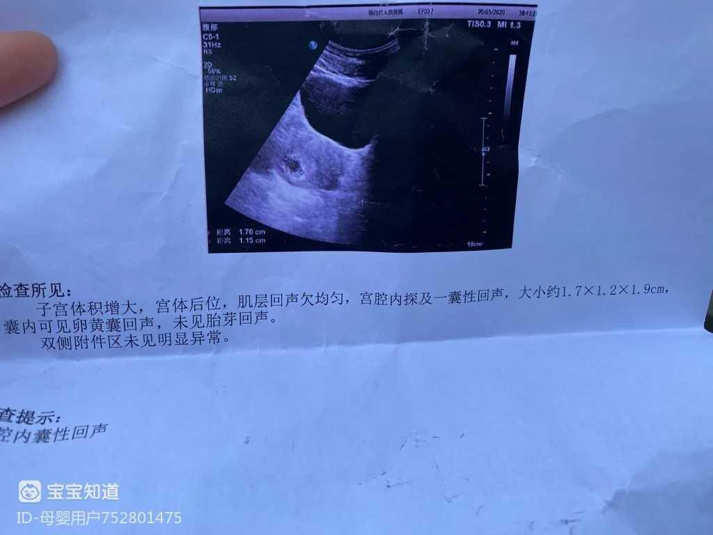单囊双胎什么时候能知道_胎囊可以判断胎儿性别吗_只看到胎囊