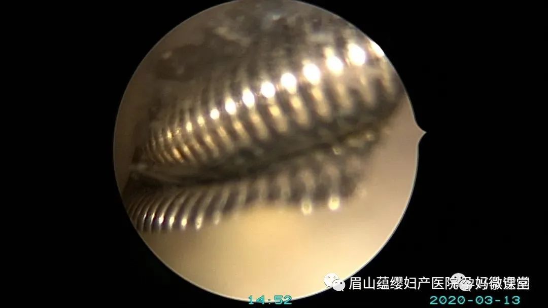 宫型环是最难取的环吗_宫型环取环步骤_取宫形环