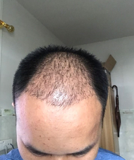 掉发严重会是什么病_掉发特别严重该怎么办_最近掉发严重怎么办