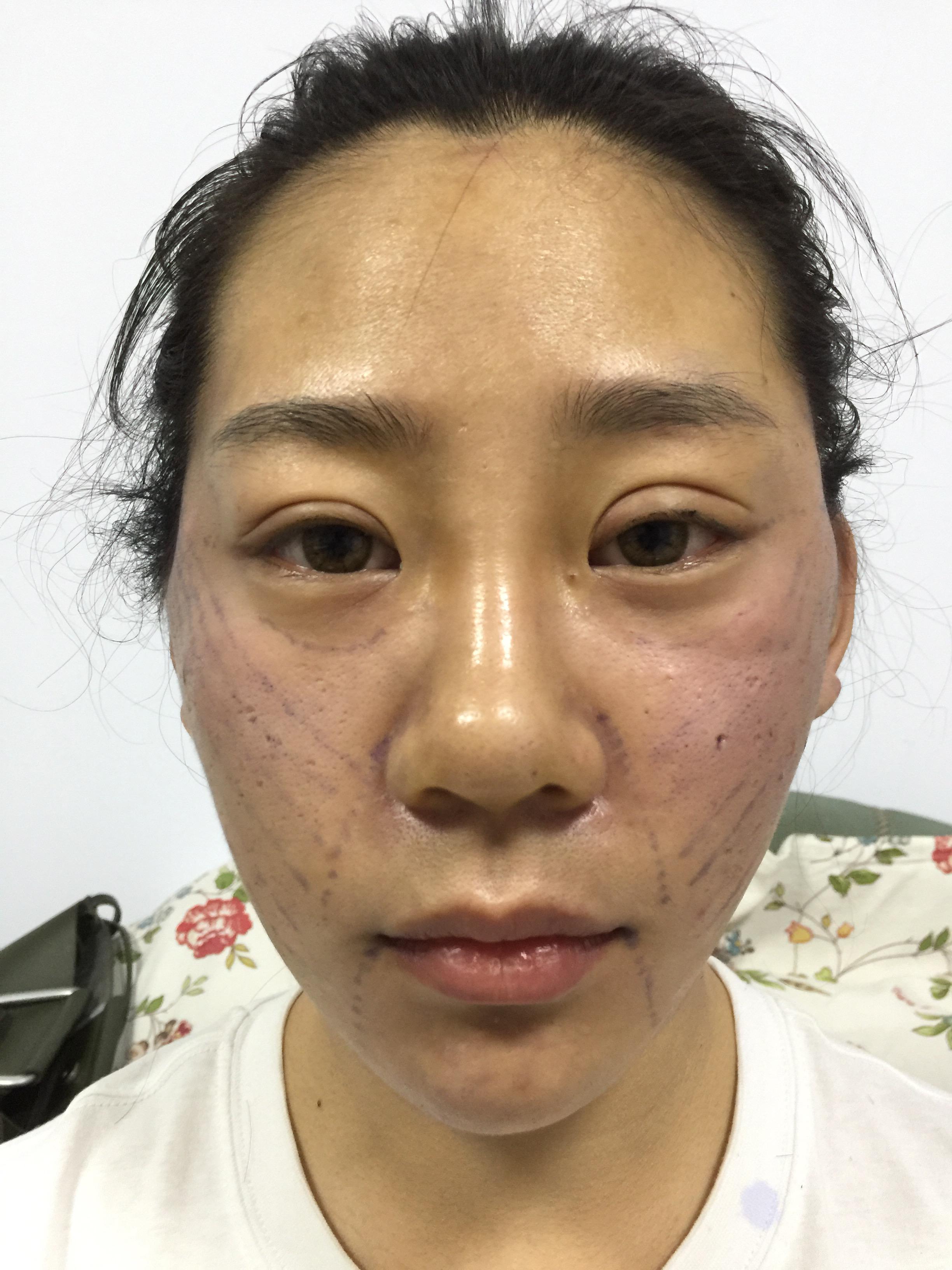 脸部打提升针可以使脸部紧致吗_v脸提升针要打20多针_打脸上的提升针好吗
