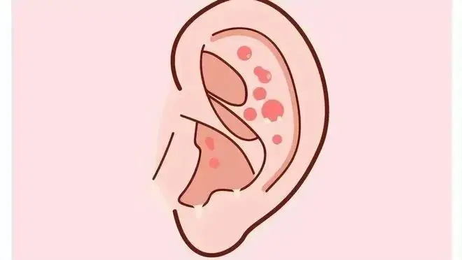 变态反应分型及代表病_变态反应性疾病定义_变态病反应型代表分型有哪些