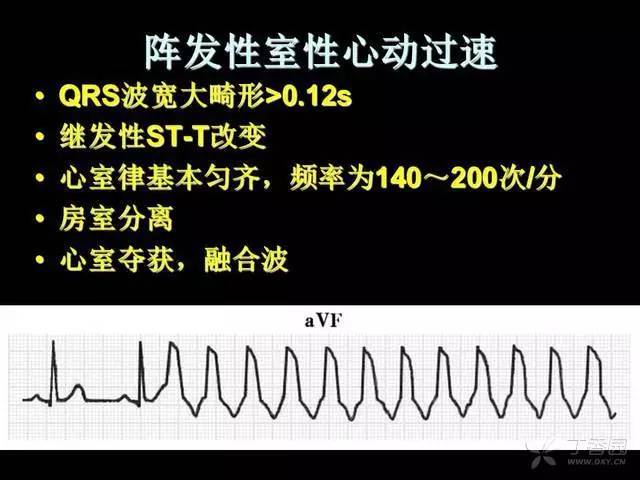 阵发性心房扑动的治疗_阵发性室上性心动过扑_心室扑动室性心动过速